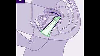 Don't use the wrong way Condom Use Mistakes (Hindi)