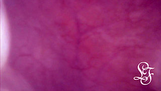 Bulge INSIDE my Bladder from Anal